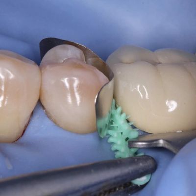 Composite Dental Sectional Matrix System Plastic Adaptive Wedges W3 1.0